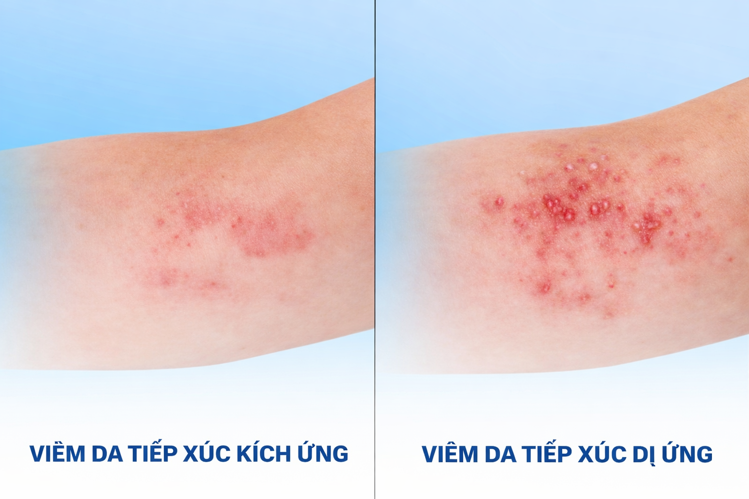 PHÂN BIỆT VIÊM DA TIẾP XÚC KÍCH ỨNG VÀ DỊ ỨNG TRONG MÔI TRƯỜNG SPA VÀ SALON